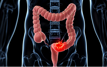 这几类人是结直肠癌的高危人群