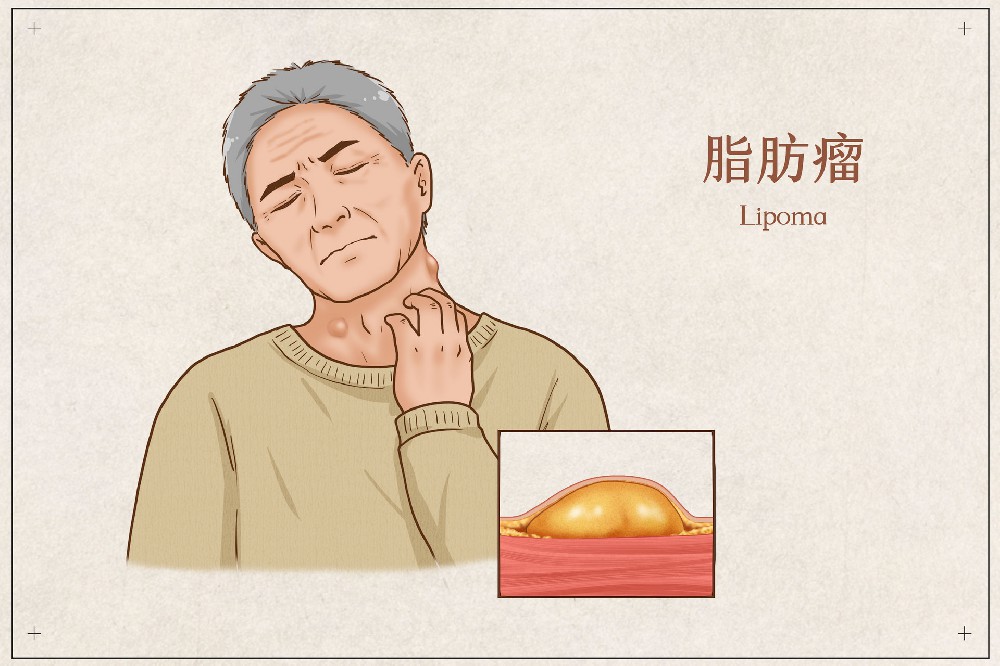 不痛不痒的“脂肪瘤”，究竟能不能留？千万别挤！