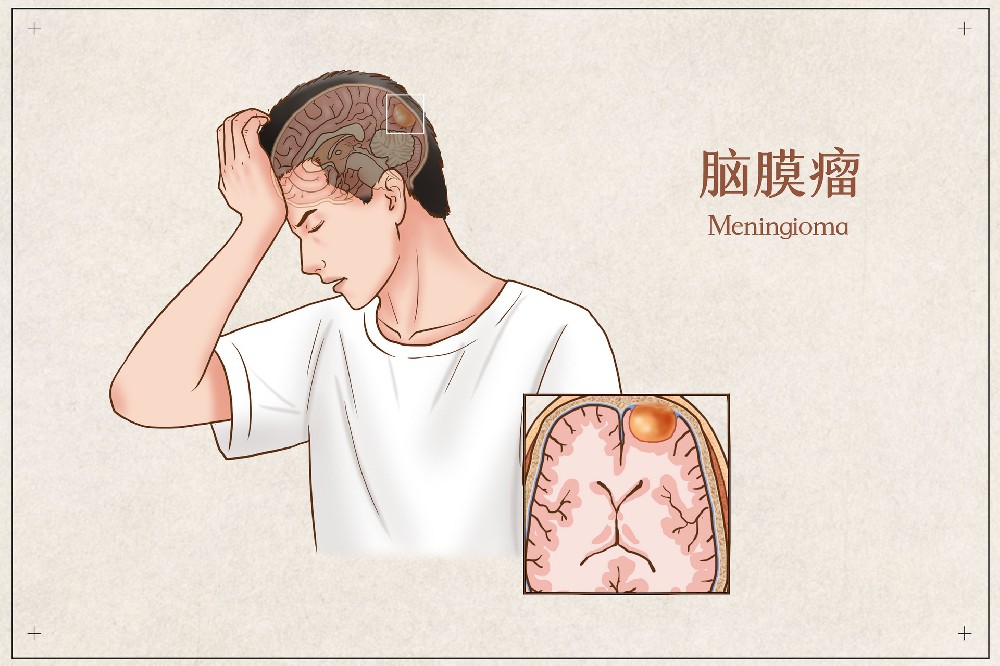 摄图网_401796585_脑膜瘤医疗插画(企业商用).jpg