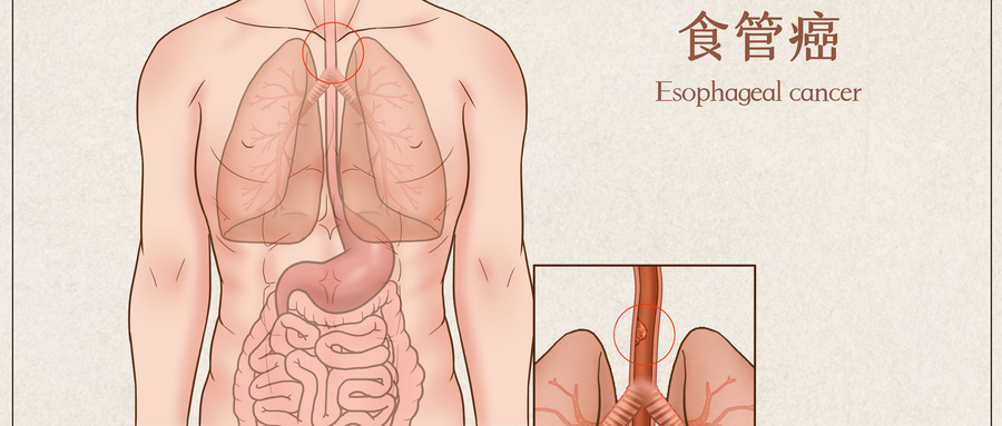 摄图网_401863169_wx_食管癌医疗插画（企业商用）.jpg