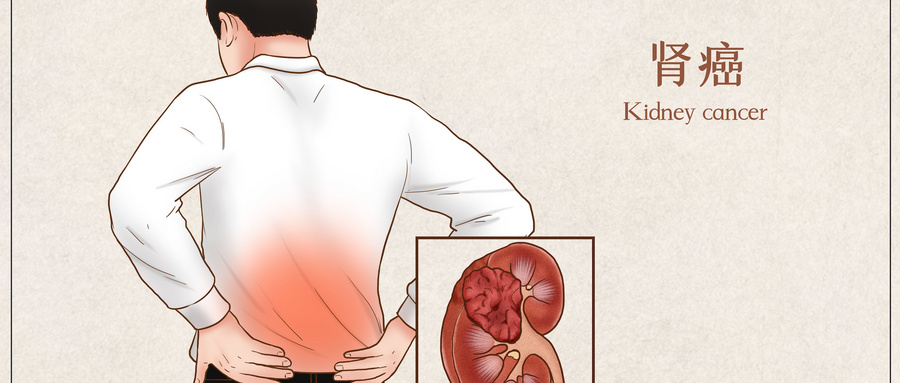 广州肾癌患者就医指南-成都普济中医-为什么肾癌不可怕？